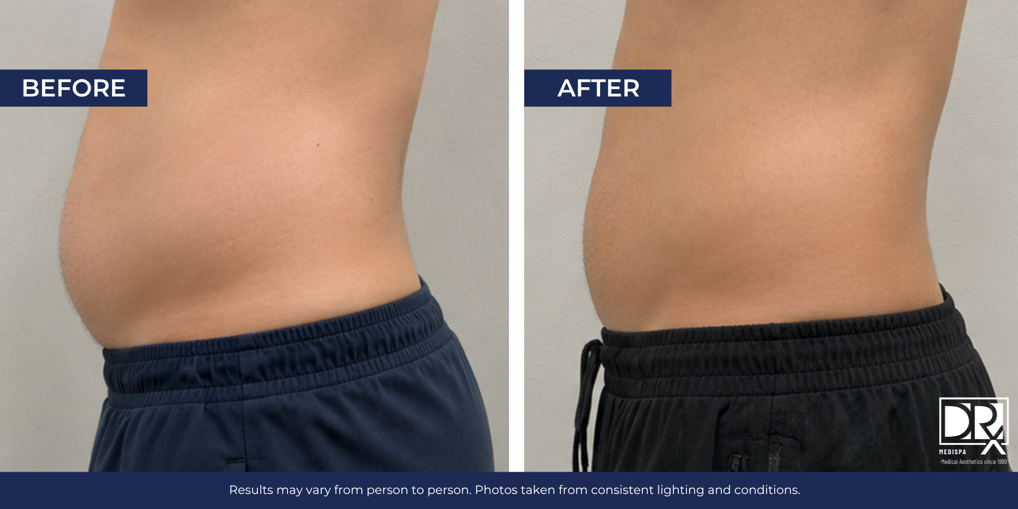 Lower Belly